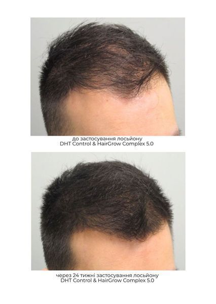 Сироватка для відновлення росту волосся DHT Control & Hairgrow Complex 5.0 DHT-CONTROL фото